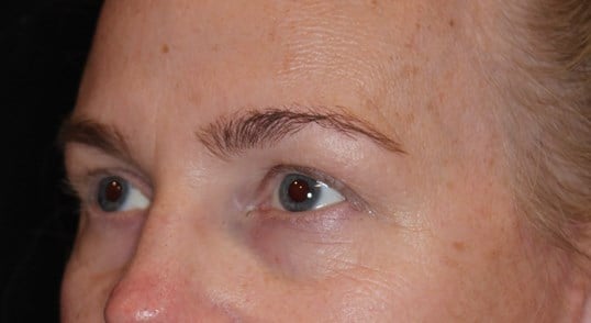 Brow Lift After