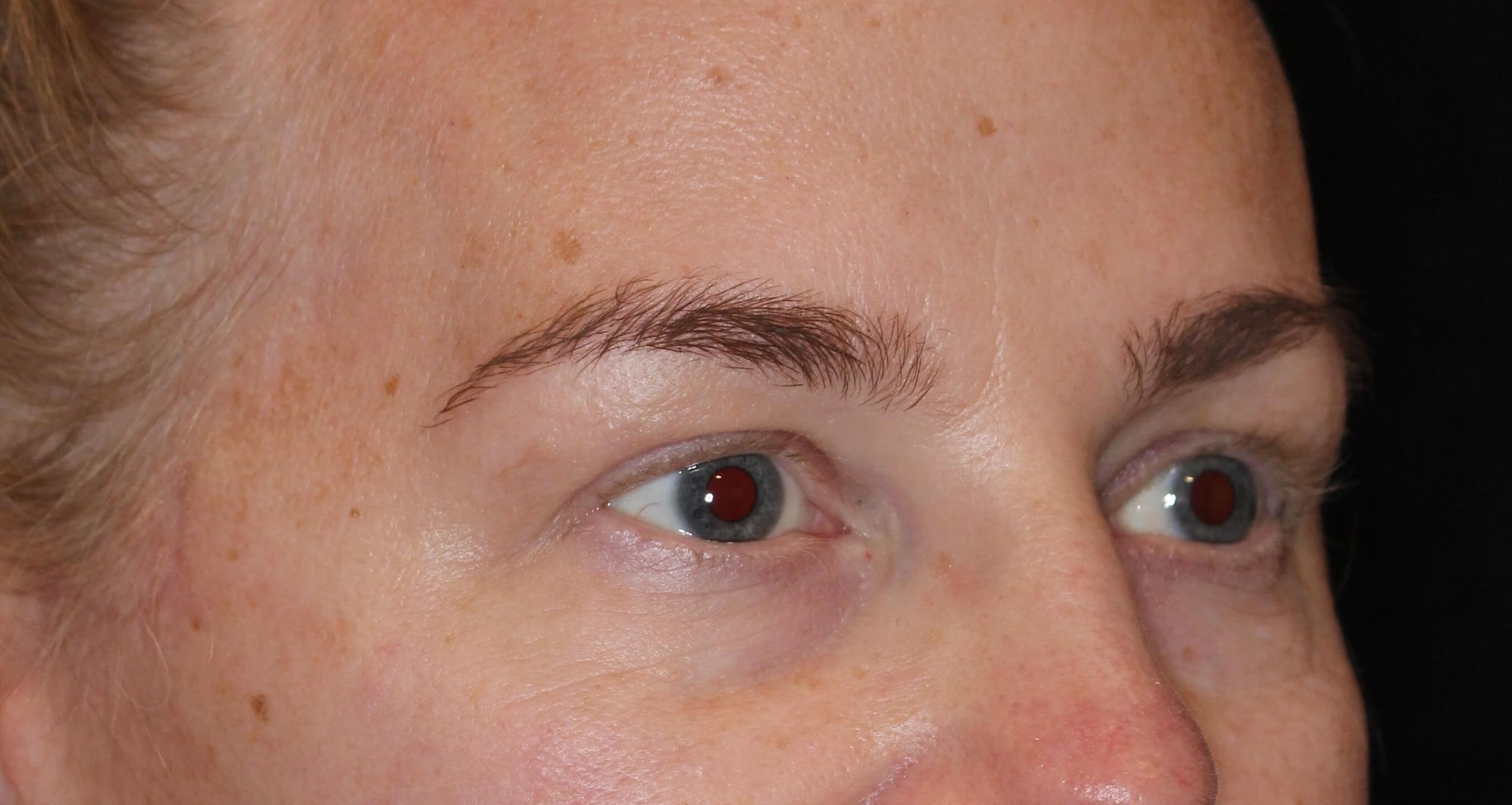 Brow Lift After