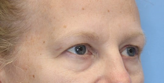 Brow Lift Before