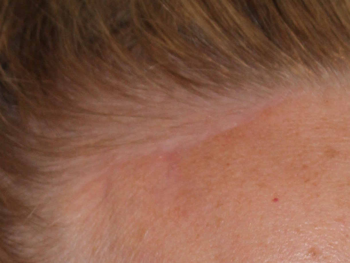 Brow Lift Scars Before