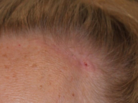 Brow Lift Scars After