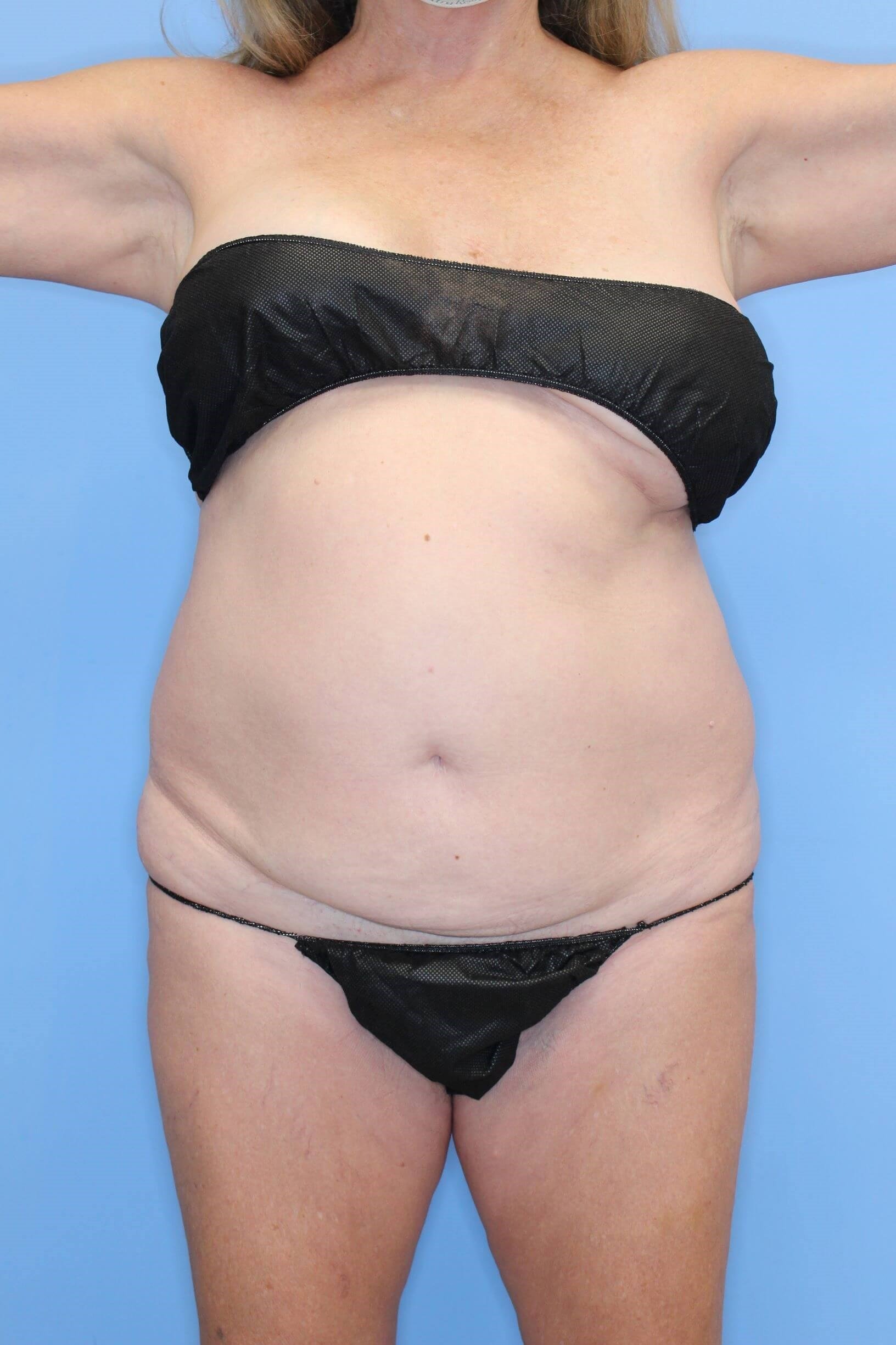 Tummy Tuck Before