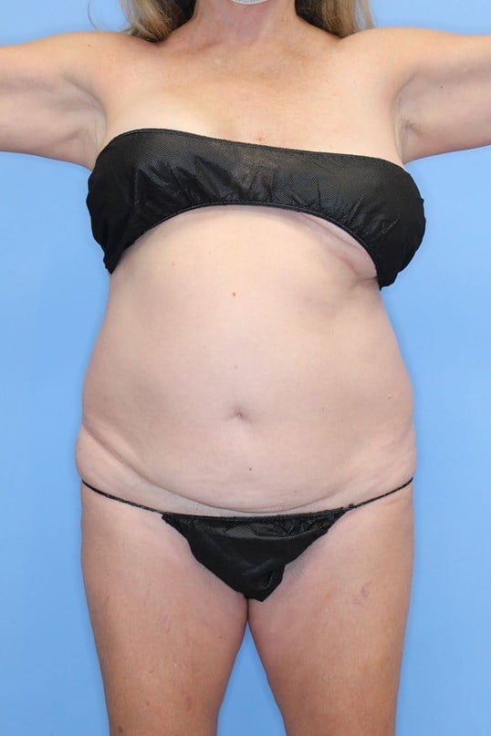 Tummy Tuck Before