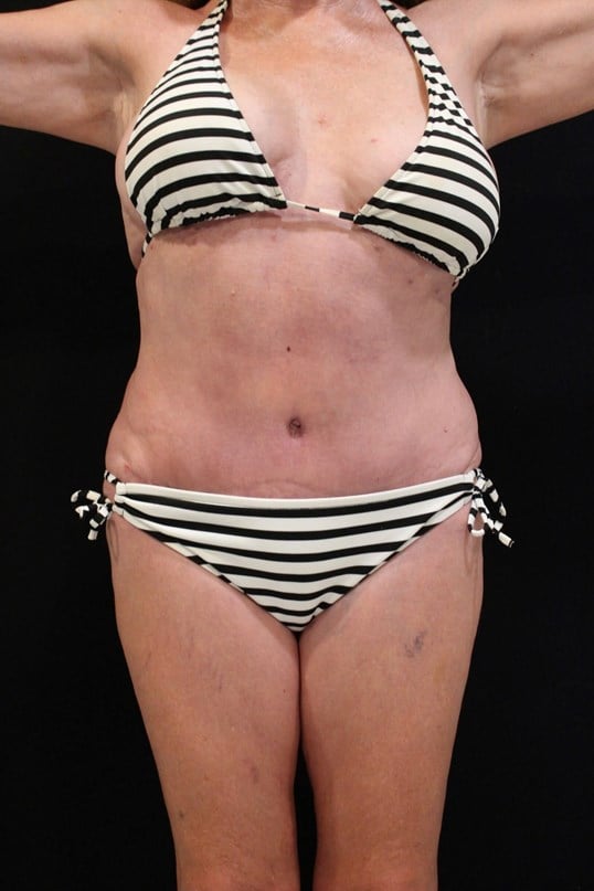 Tummy Tuck After