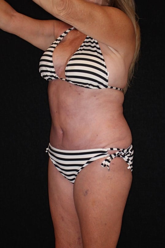 Tummy Tuck After