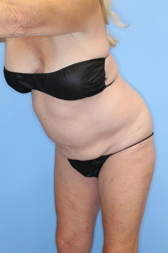 Tummy Tuck Before