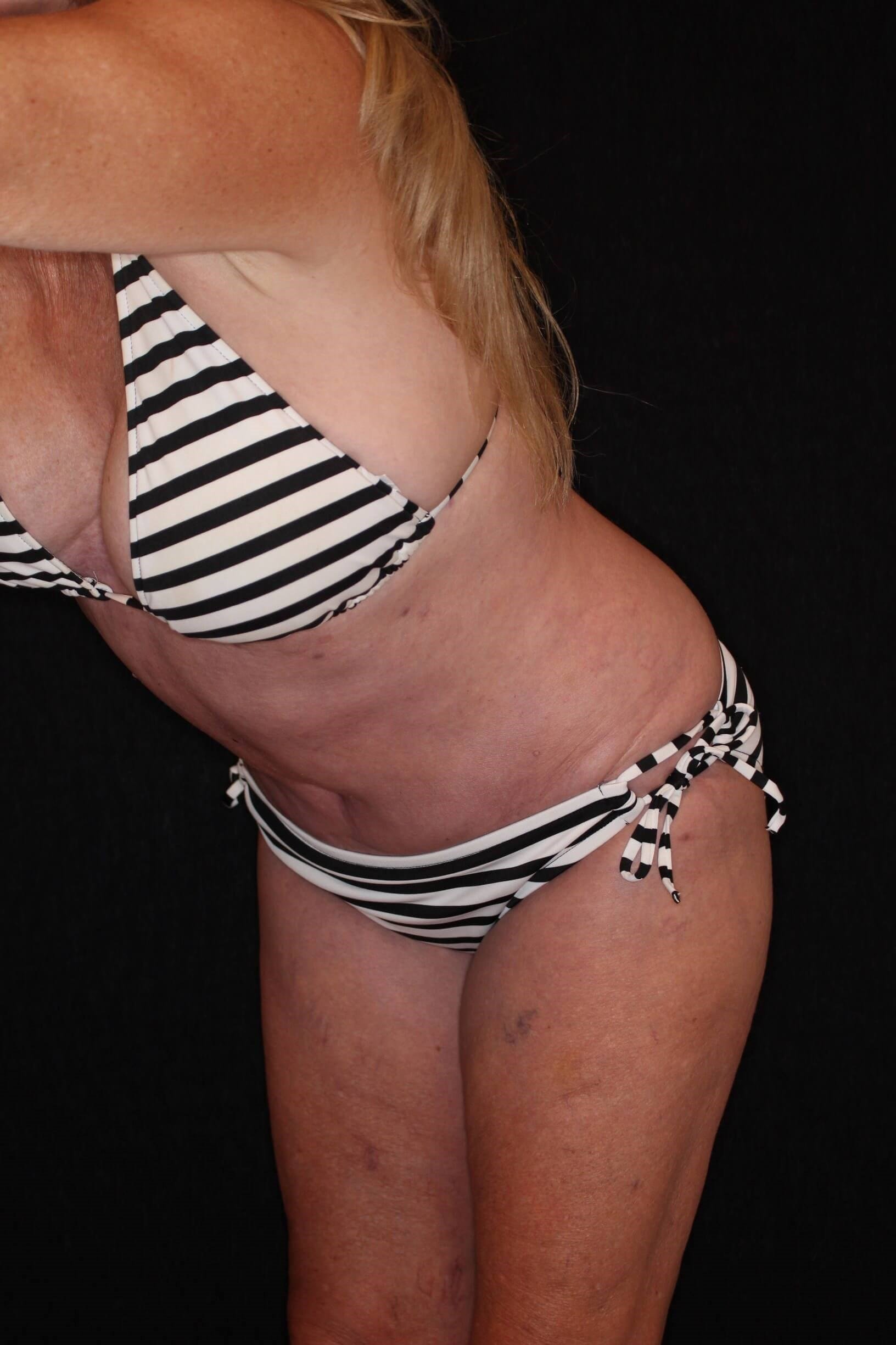 Tummy Tuck After