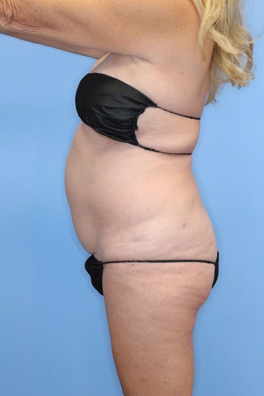 Tummy Tuck Before