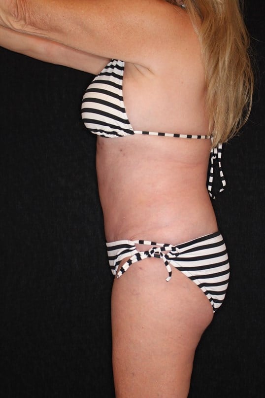 Tummy Tuck After