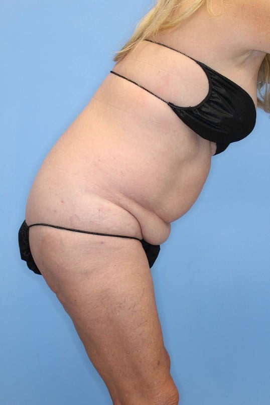 Tummy Tuck Before