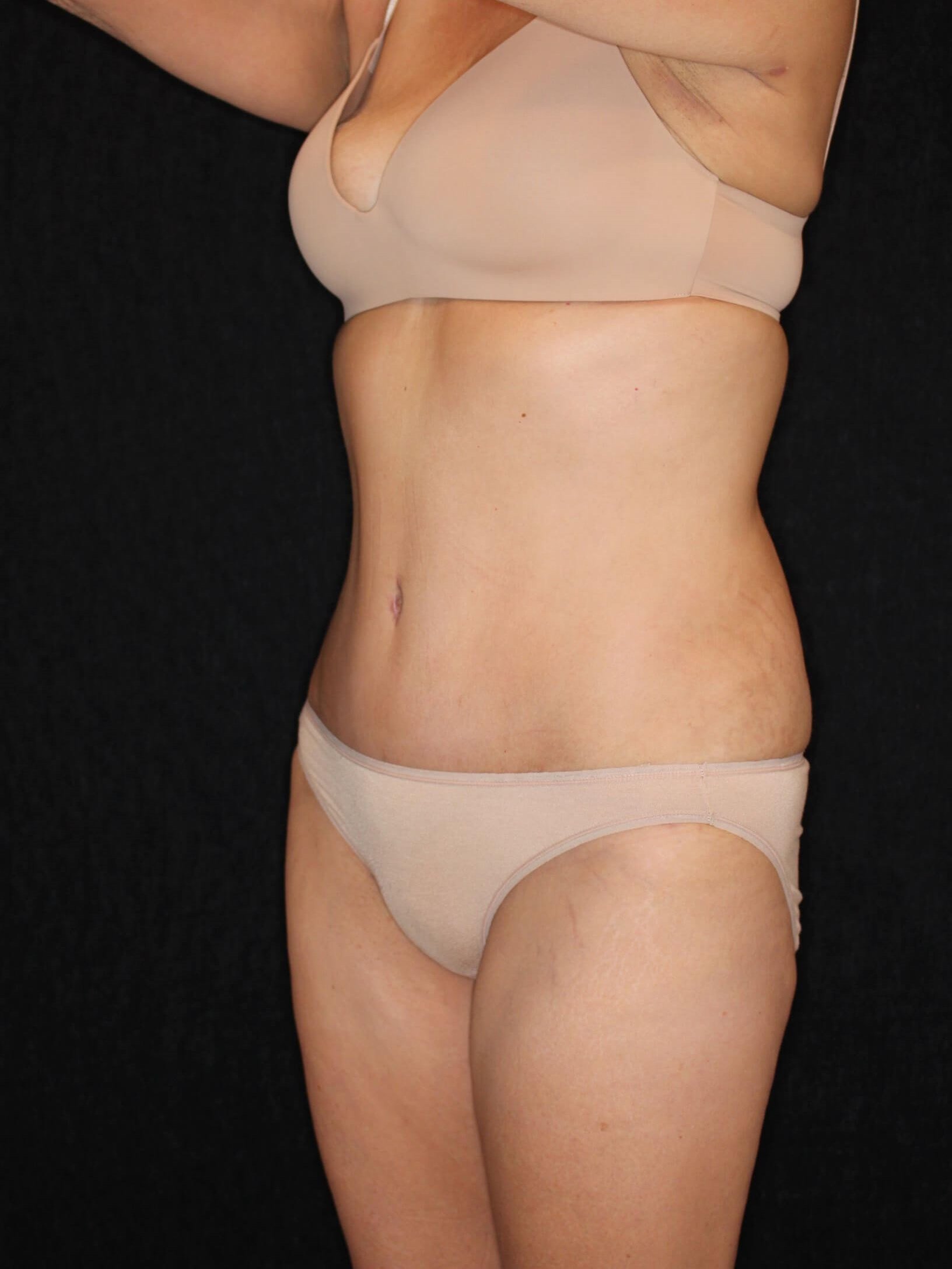 Tummy Tuck After