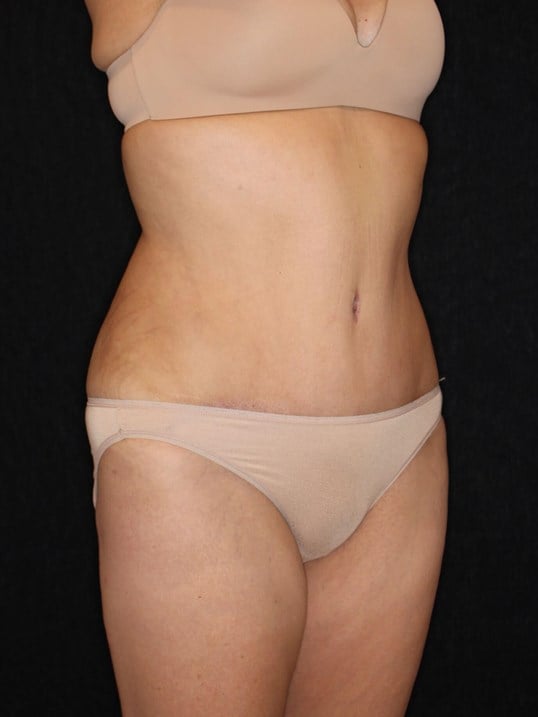 Tummy Tuck After