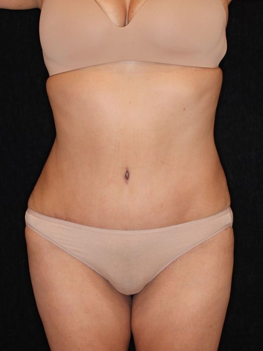 Tummy Tuck After