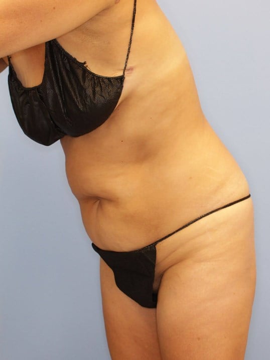 Tummy Tuck Before