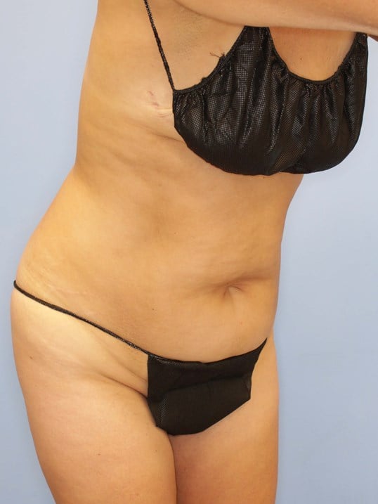 Tummy Tuck Before