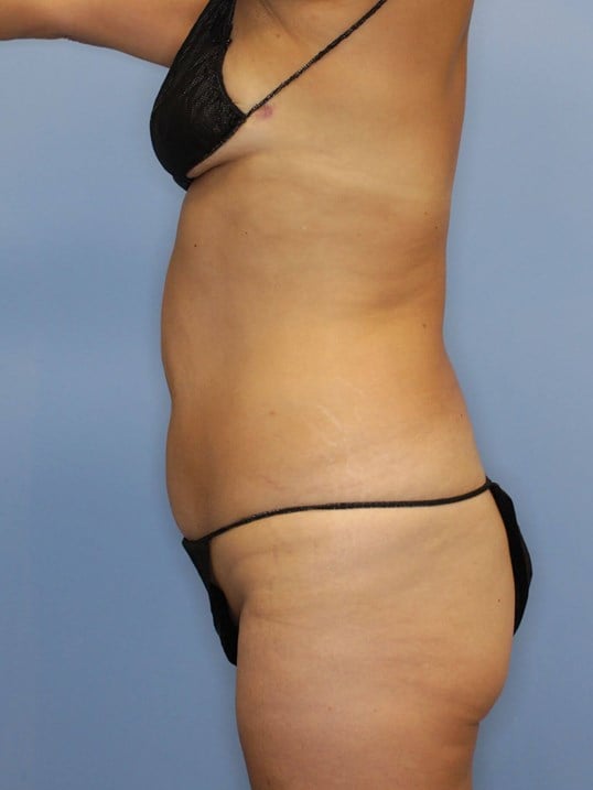 Tummy Tuck Before