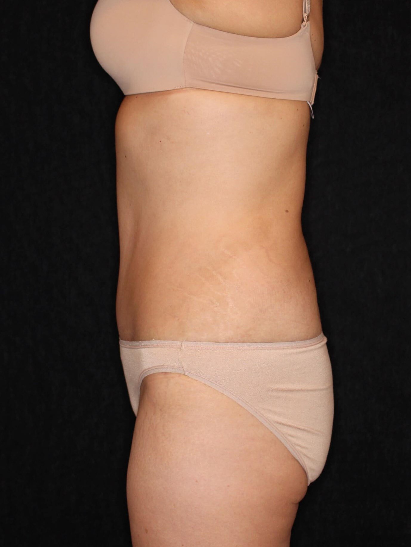 Tummy Tuck After