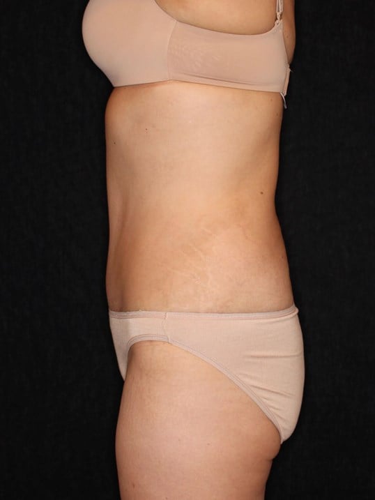 Tummy Tuck After