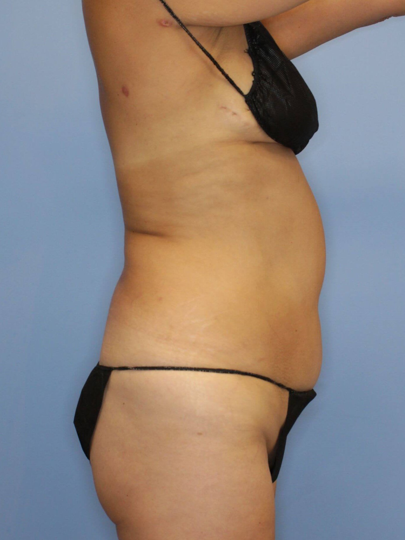 Tummy Tuck Before