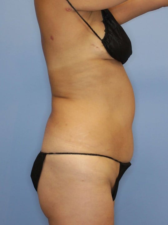 Tummy Tuck Before