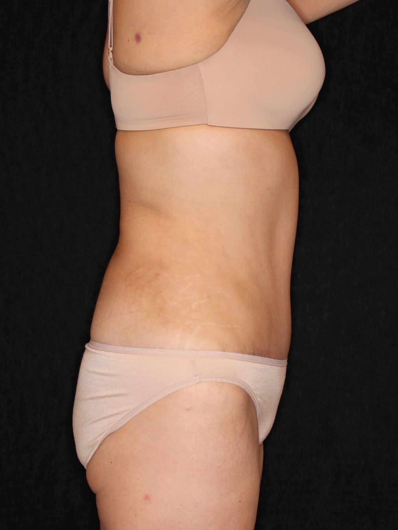 Tummy Tuck After
