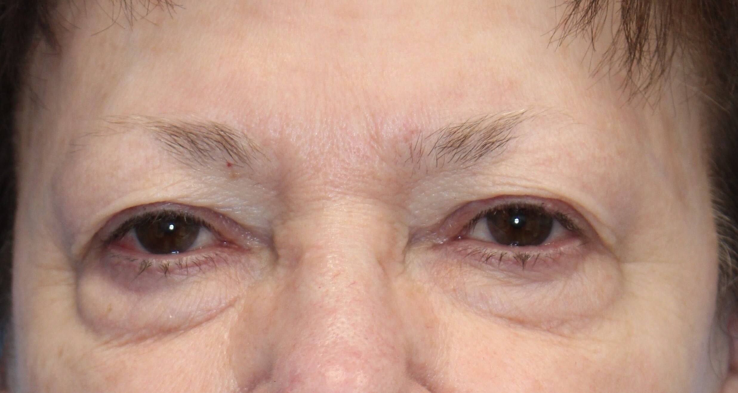 Upper & Lower Eyelid Lift Before