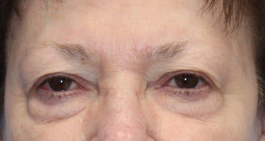 Upper & Lower Eyelid Lift Before