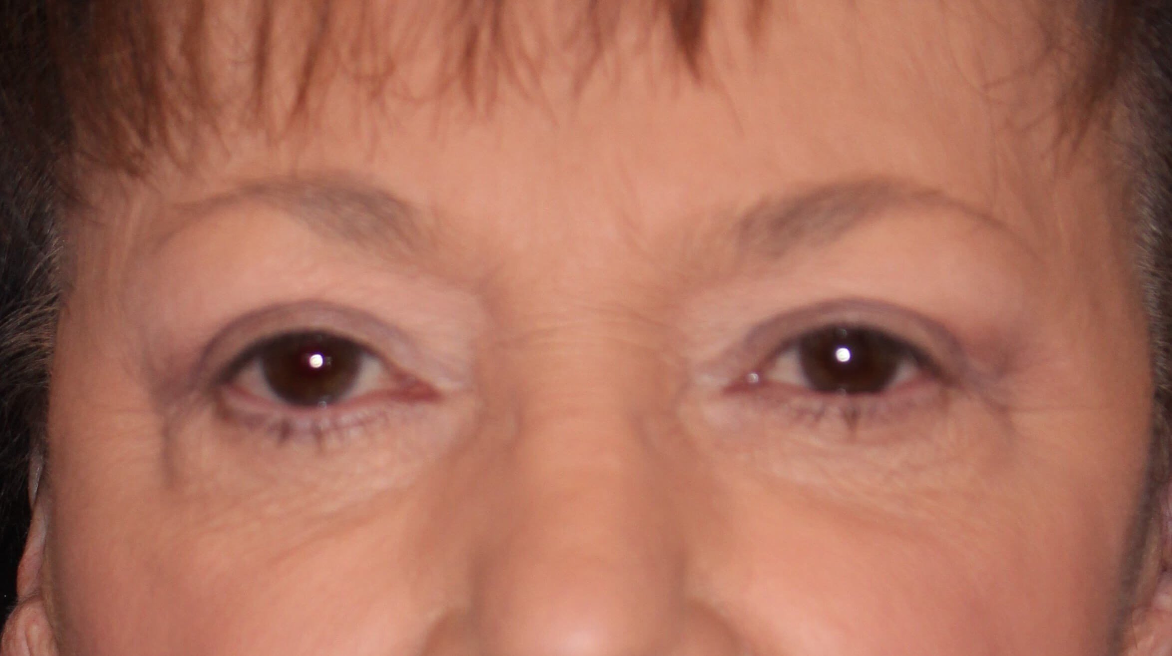 Upper & Lower Eyelid Lift After