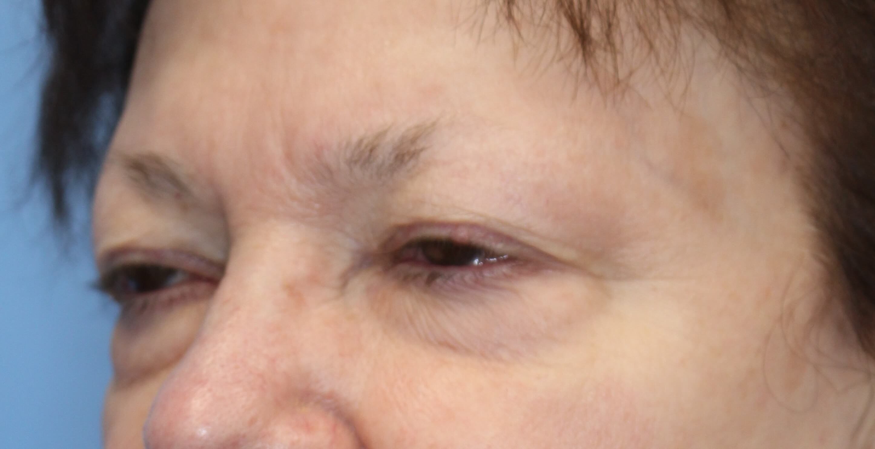 Upper & Lower Eyelid Lift Before