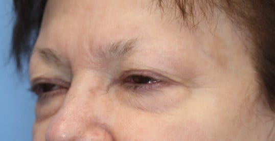 Upper & Lower Eyelid Lift Before