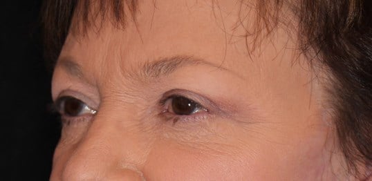 Upper & Lower Eyelid Lift After