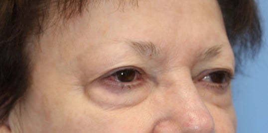 Upper & Lower Eyelid Lift Before