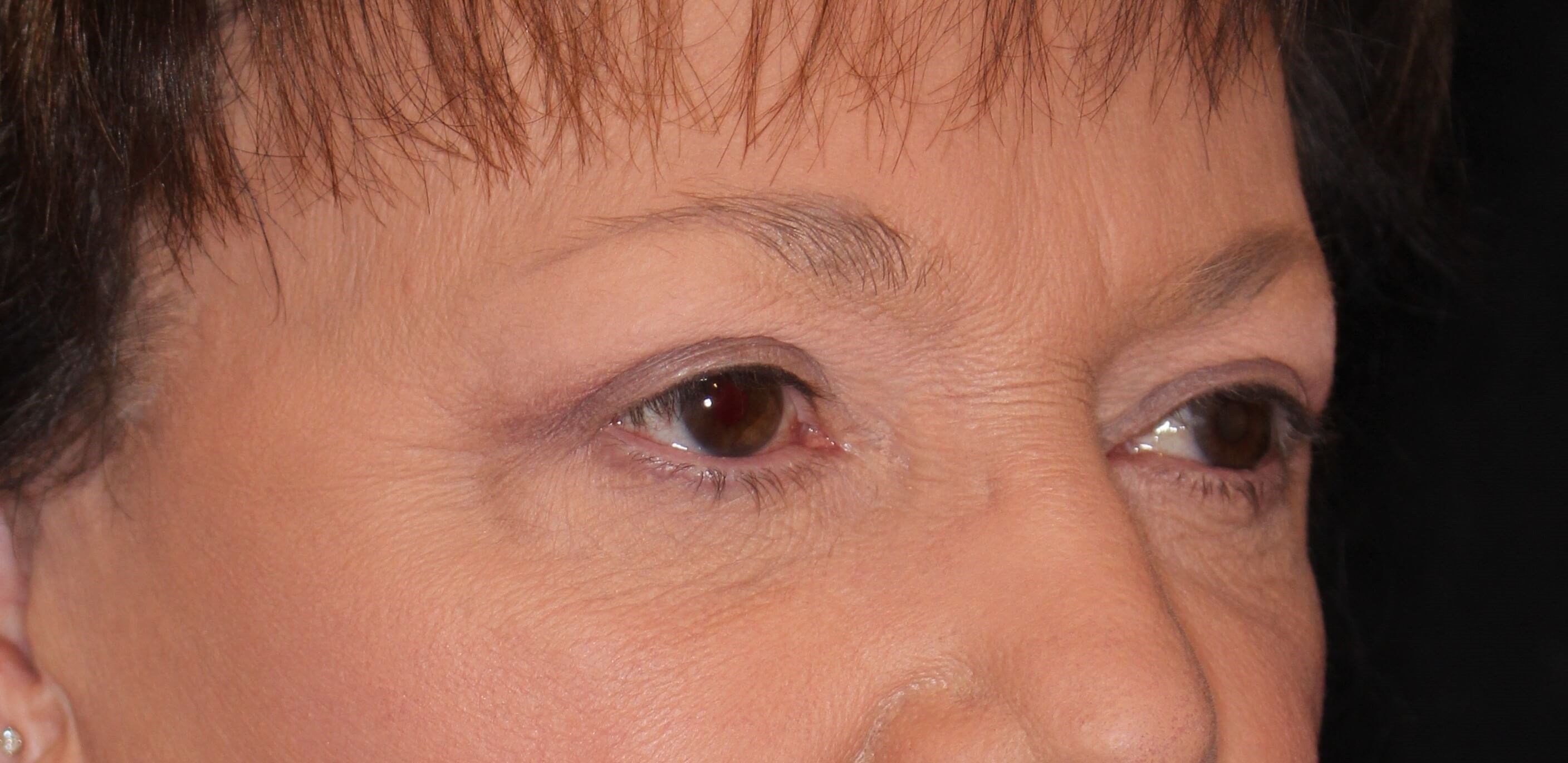 Upper & Lower Eyelid Lift After
