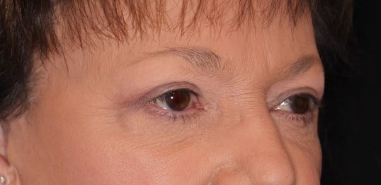 Upper & Lower Eyelid Lift After