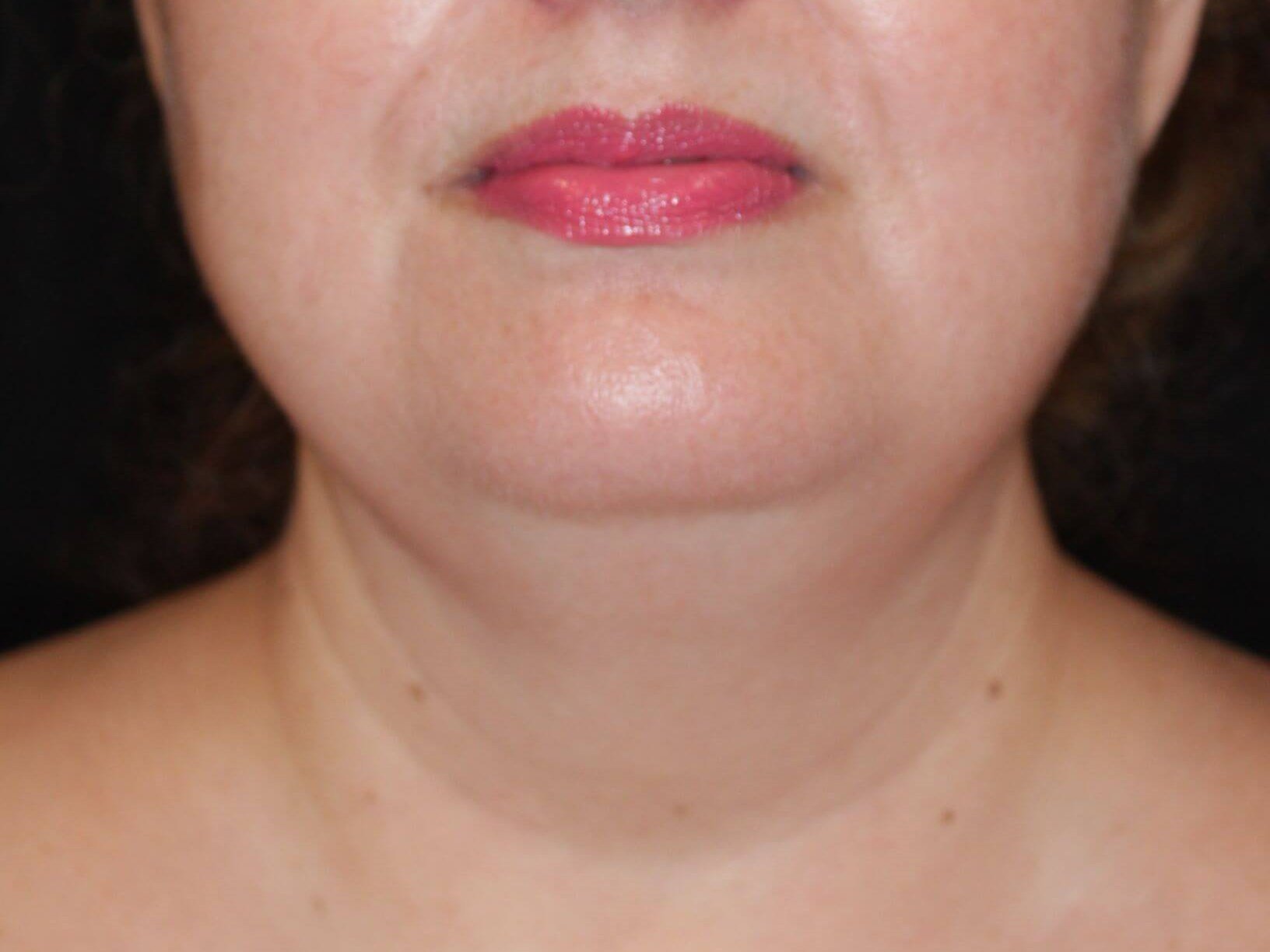 Jaw Contouring Before