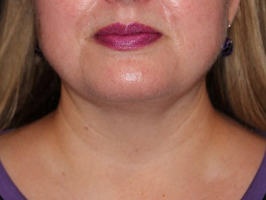 Jaw Contouring After