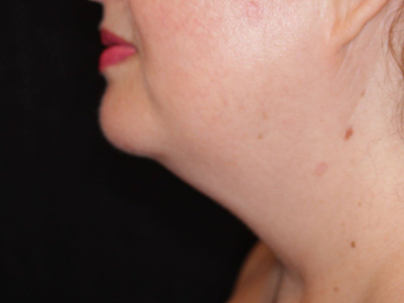 Jaw Contouring Before