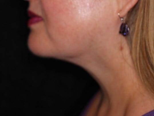 Jaw Contouring After