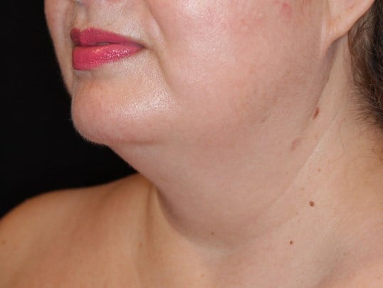 Jaw Contouring Before