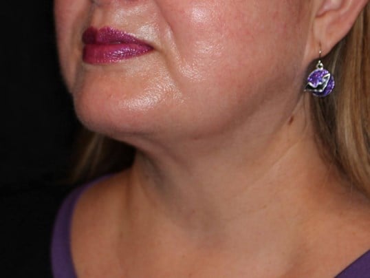 Jaw Contouring After