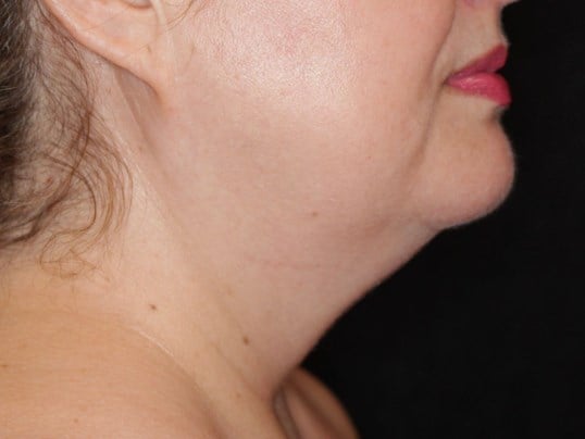 Jaw Contouring Before