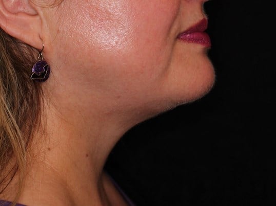 Jaw Contouring After