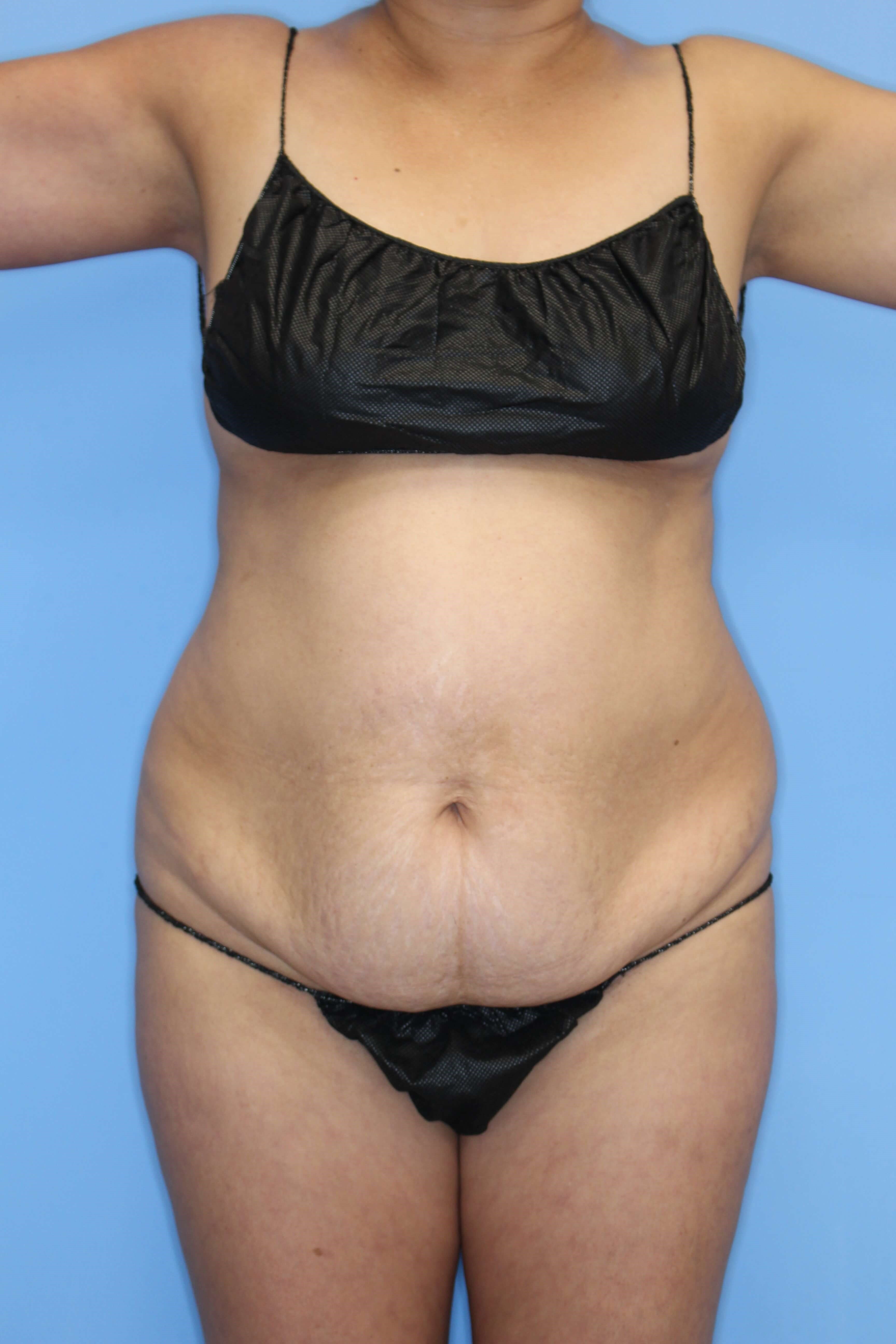 Abdominoplasty Before