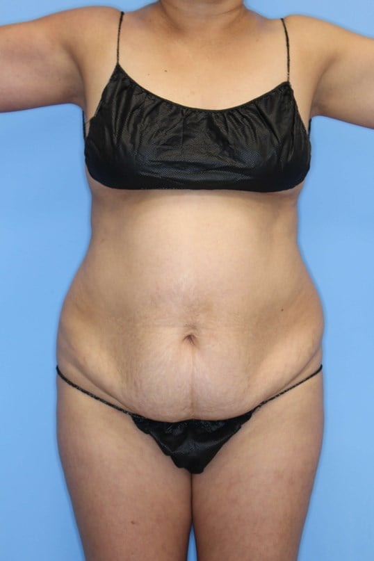 Abdominoplasty Before