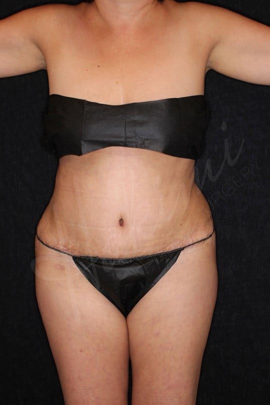 Abdominoplasty After