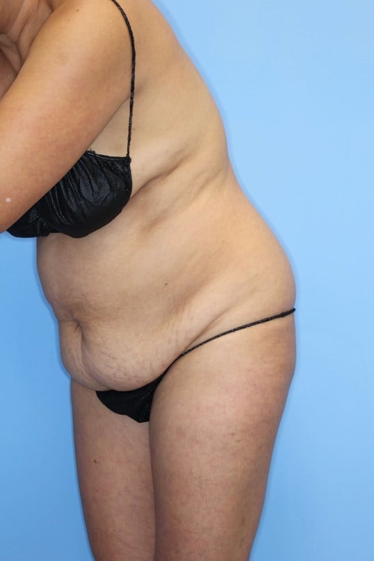 Abdominoplasty Before