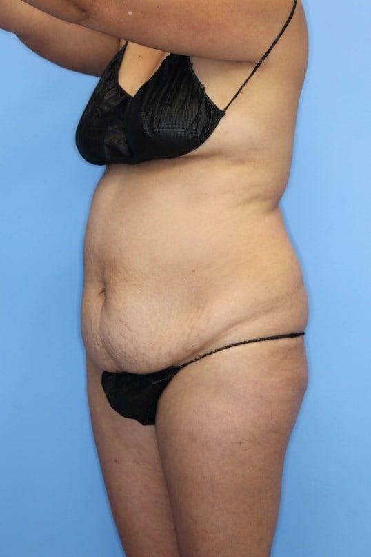 Abdominoplasty Before