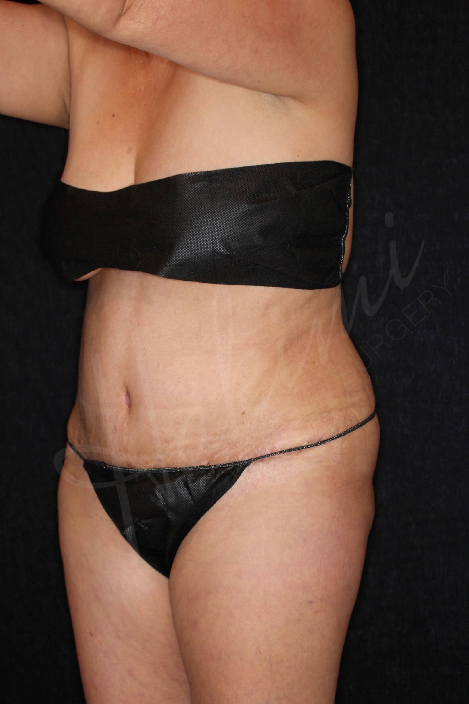 Abdominoplasty After