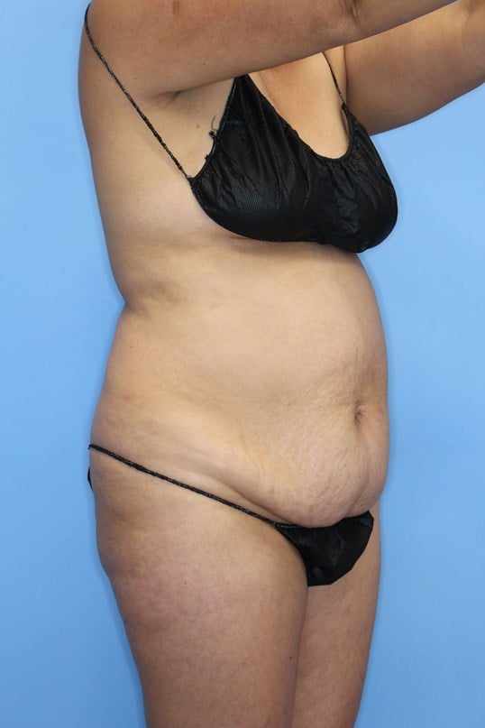 Abdominoplasty Before