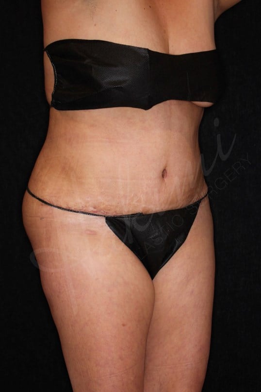 Abdominoplasty After